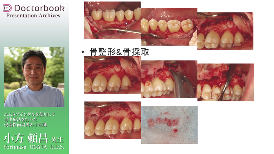 動画紹介］歯周治療をマスターしよう Part2 | Doctorbook academy 